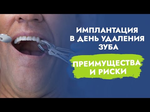 Имплантация после удаления зуба. Когда? Как снизить риски?