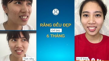 Vĩnh biệt răng kẹ - cười đẹp tự tin với giải pháp niềng răng