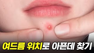 아프면 여기 여드름이 난다고?