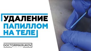 Удаление папиллом на теле в Ростове-на-Дону #удалениепапилломростов