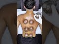 Fire Cupping Therapy | Natural Solution Back Pain |✅ Therapy Explained