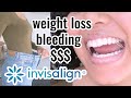 11 Things I was NOT EXPECTING with Invisalign