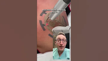 How Does Laser Tattoo Removal Work 