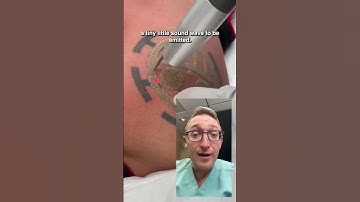 How Does Laser Tattoo Removal Work?