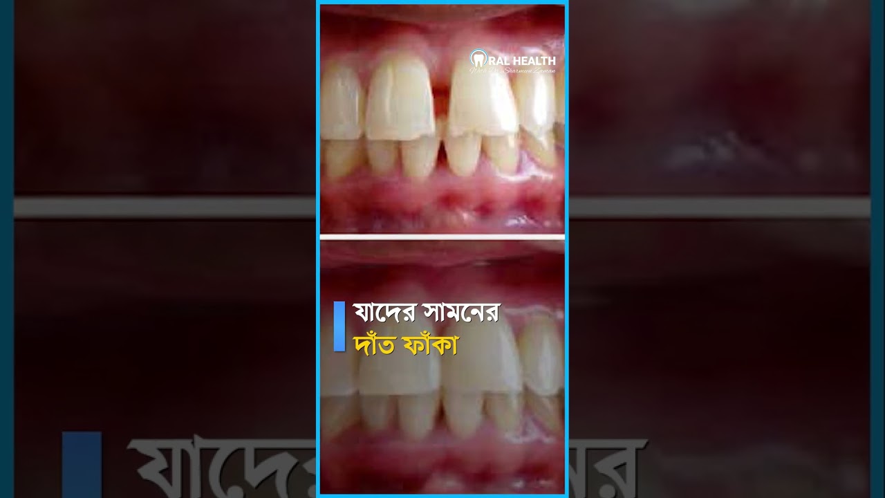 ⁣ফাঁকা দাঁতের সহজ চিকিৎসা | Dr.sharmeen Zaman