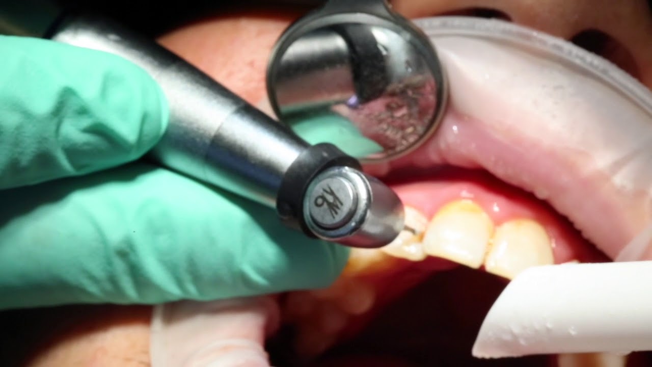 Solea Laser Cavity Removal YouTube