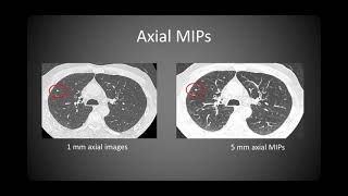 Imaging Lung cancer screening