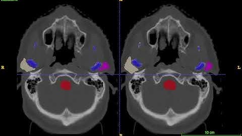 AnatomyNet-for-anatomical-segmentation test demo 0
