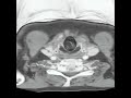 Virtual Bronchoscopy