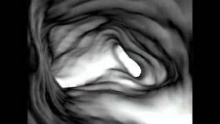 Virtual Bronchoscopy