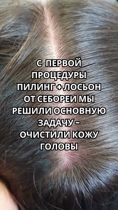 Жирная себорея. Пилинг кожи головы. #уходзаволосами #волосы #hair # ...