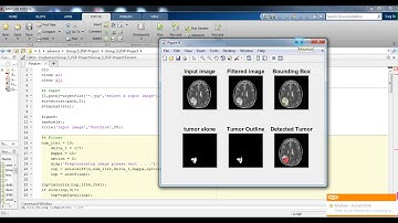 Brain Tumor Detection classification & Segmentation in Matlab | +91-9872993883 for query| Matlab
