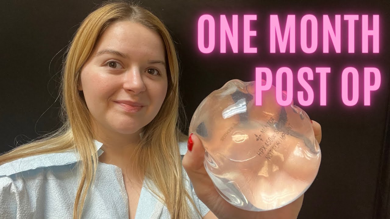 Breast Augmentation 1 Month Post Op Update! Implant Exchange with a