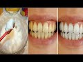 Com apenas uma Aplicação elimina todos TARTARO dos Dentes e Clareia