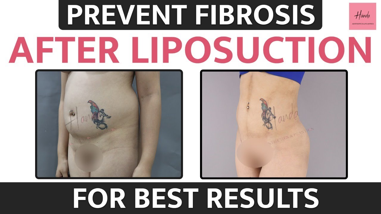 What is Fibrosis? | Fibrosis After Liposuction | How to Prevent