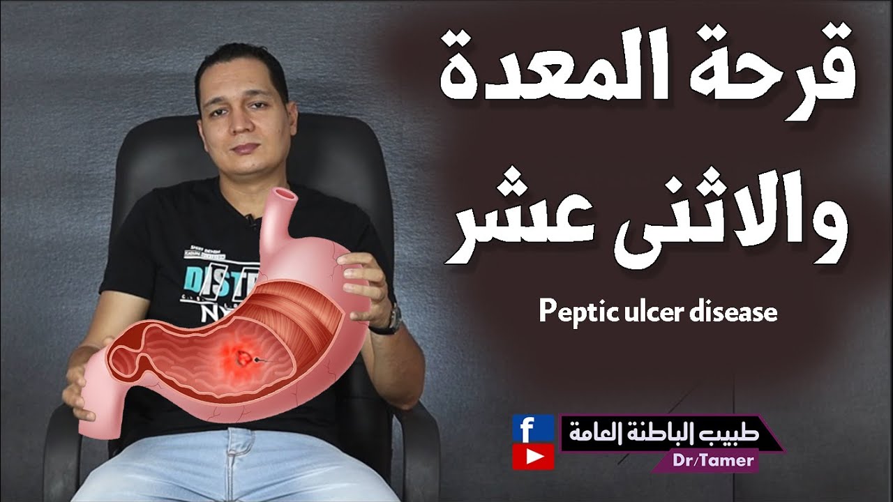 قرحة المعدة والاثنى عشر /PUD