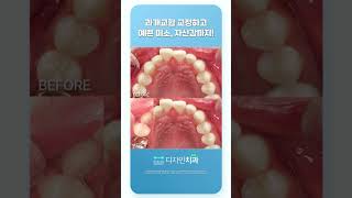 디자인치과에서 교정하고 달라졌어요 #부정교합 #치아교정전후