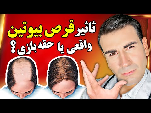 آیا مصرف قرص بیوتین واقعا از ریزش مو جلوگیری میکنه و باعث رشد مجدد مو میشه Biotin And Hair Loss