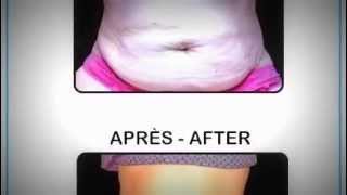 Lipo Cavitation Studio Mmv