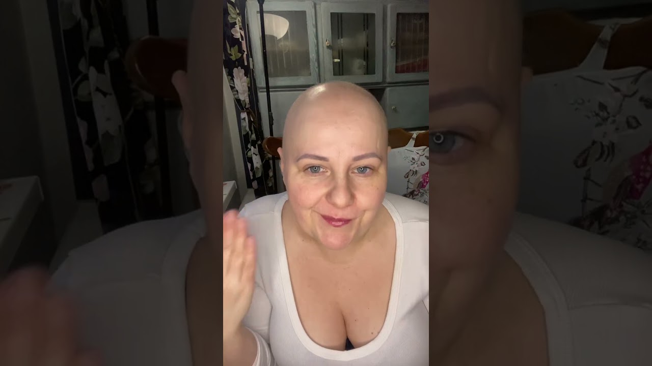 100 dni leczenia biologicznego na łysienie plackowate