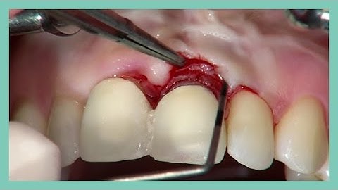 Esthetic crown lengthening