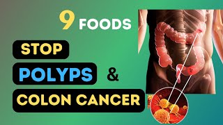 9 Foods to Get Rid of Colon Polyps and Stop Bowel Cancer