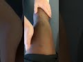 Positive swipe test ACL grade 2