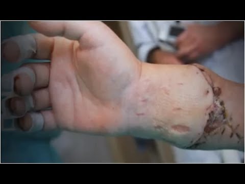 Przyszyli mu cudzą rękę i znów mógł zagrać na pianinie! [36,6]