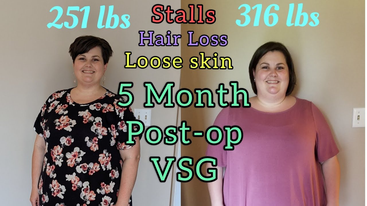 5 Month PostOp VSG surgery Stalls Hair loss Loose skin YouTube