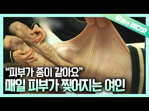 <strong>40년</strong> 동안 재생되지 못한 피부의 비밀┃Failing to Regenerate <strong>for</strong> 40 Years and Its Secret Has Been Unveiled