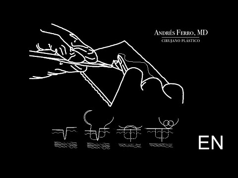 English - Practice # 05: Uneven Wound Correction - Dr. Andres Ferro.