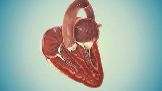 Cusper procedure animation