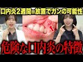2週間治らない口内炎…放置すると危険です