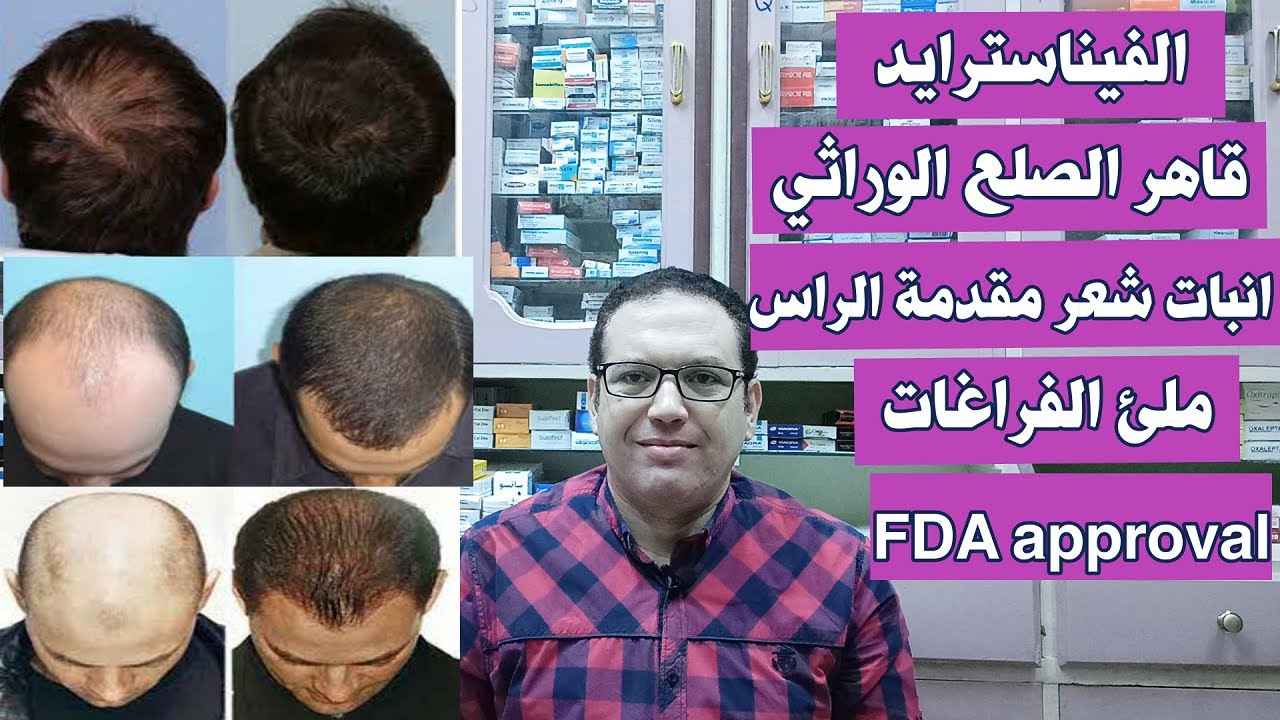 الفيناسترايد قاهر الصلع الوراثي وانبات الشعر في مقدمة الراس وطريقة استخدامه بامان وبدون اثار جانبيه