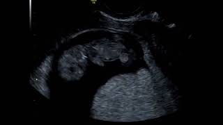 What Can You See At A 10 Week Baby Scan?