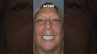 Before and after #dentalimplants #smile