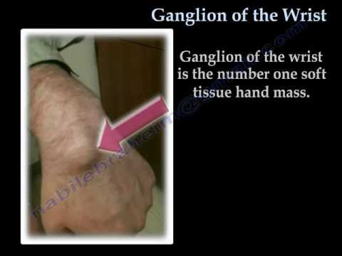 Carpal Tunnel Injection - Everything You Need To Know - Dr. Nabil Ebraheim  