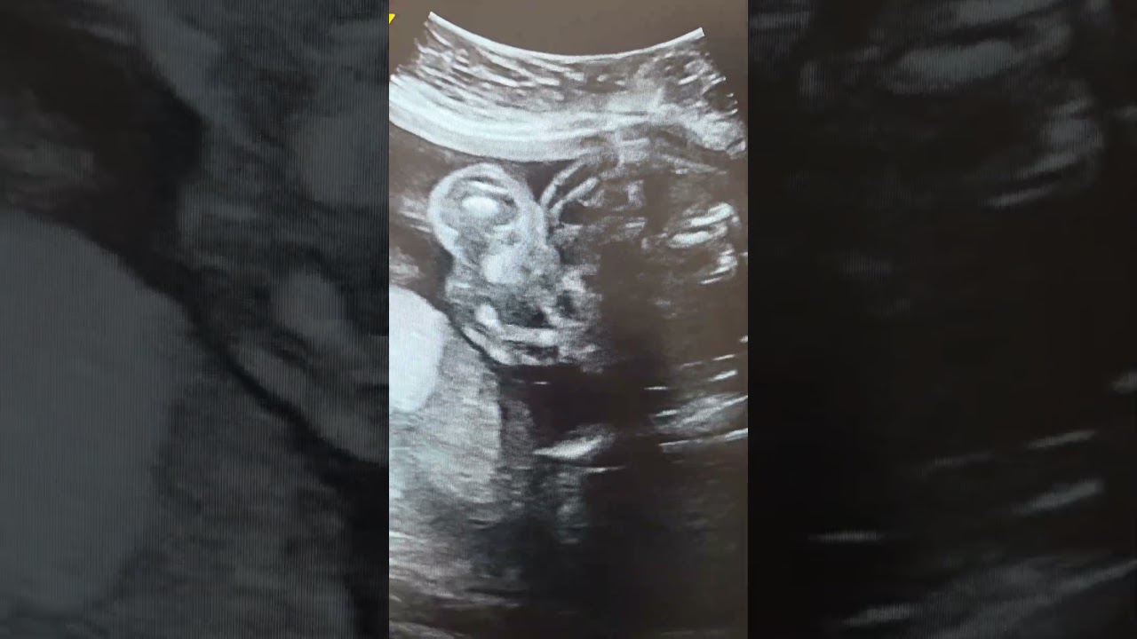 Echogenic bowel in the fetus