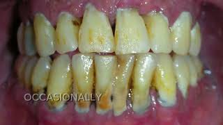 I Have Gum Disease. My Dentist Told Me I Got Gum Disease