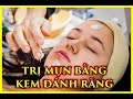 Trị mụn trứng cá bằng kem đánh răng  : Lợi 1 Hại 10