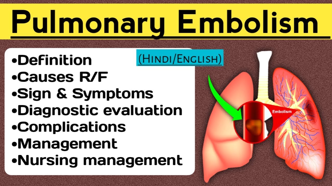 pulmonary-embolism-lecture-in-hindi-pulmonaryembolism-nursingcriteria