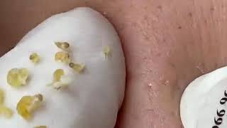 NEW VIDEOS 2026 😱 GIANT BLACKHEAD REMOVAL (SHOCKING!)