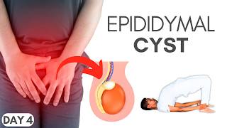 Day 4: Spermatocele Relief: How to Shrink Epididymal Cysts Naturally