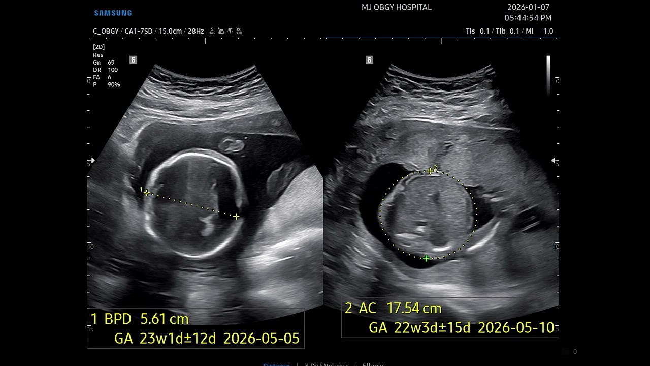 2026.01.07 땡글이 초음파 16