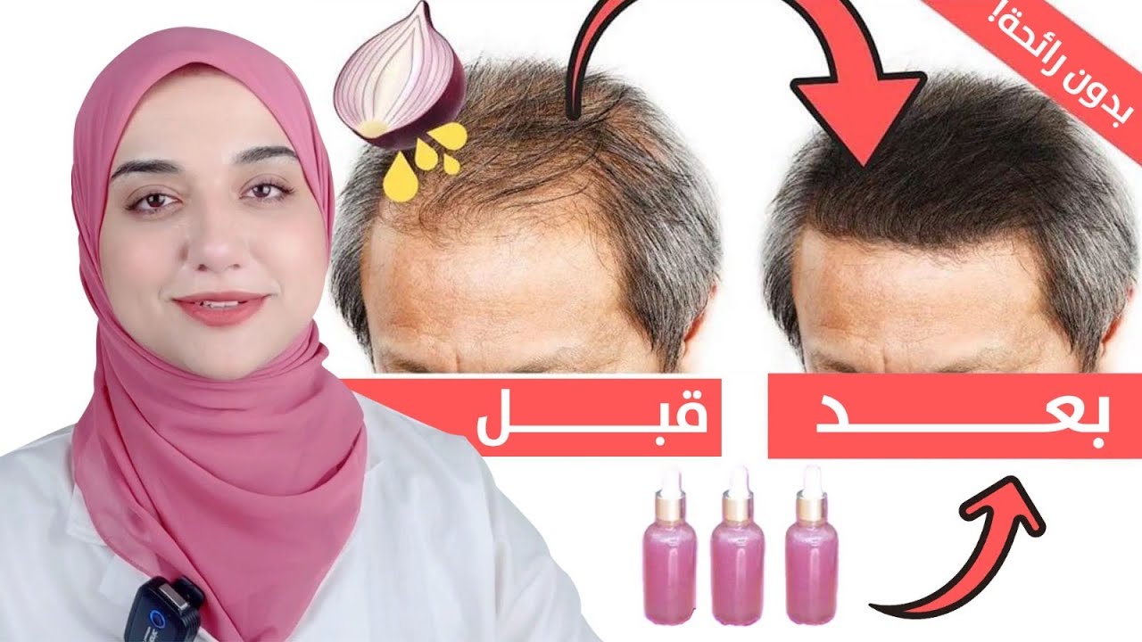 طريقة تحضير ماء البصل و زيت البصل للشعر الضعيف / سحر البصل لتعبئة الفراغات و لتطويل الشعر في ايام