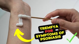 Tremfya Medication Side Effects The Groundbreaking Treatment For Psoriasis