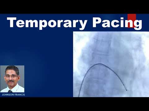 Temporary Pacing