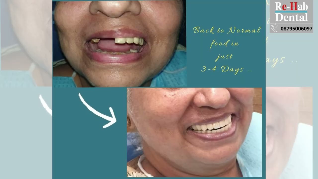 Dental Implants For A Lifetime Beautiful Smile - Dr Rohit Yadav | Rehab Dental Clinic