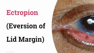 Ectropion eversion of eyelid margin