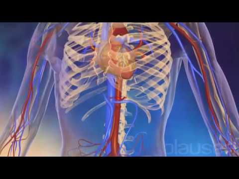 Хронический миелолейкоз   The Philadelphia Chromosome